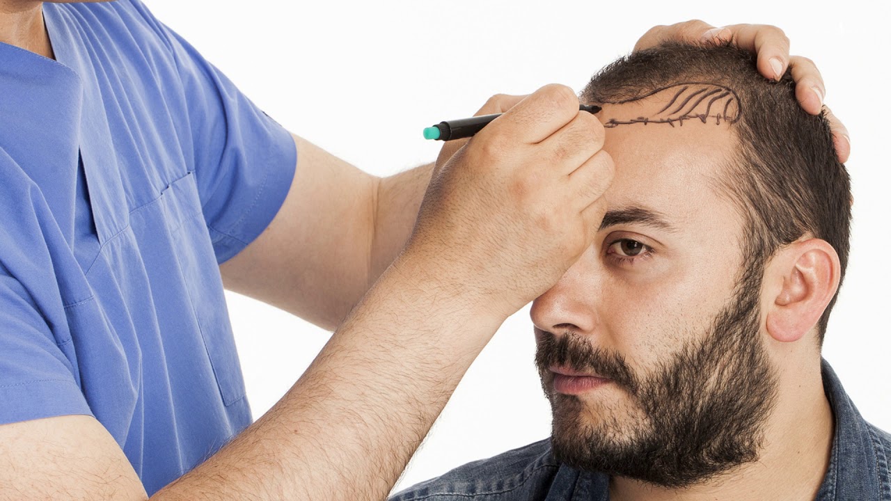 Hair Transplantation