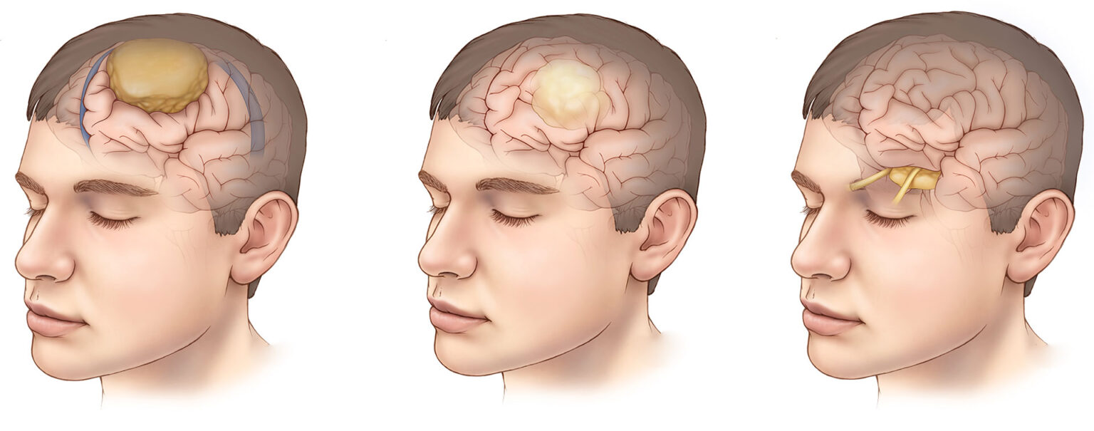 Early signs of a brain tumor