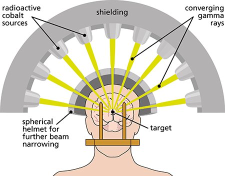 Gamma Knife Radiosurgery